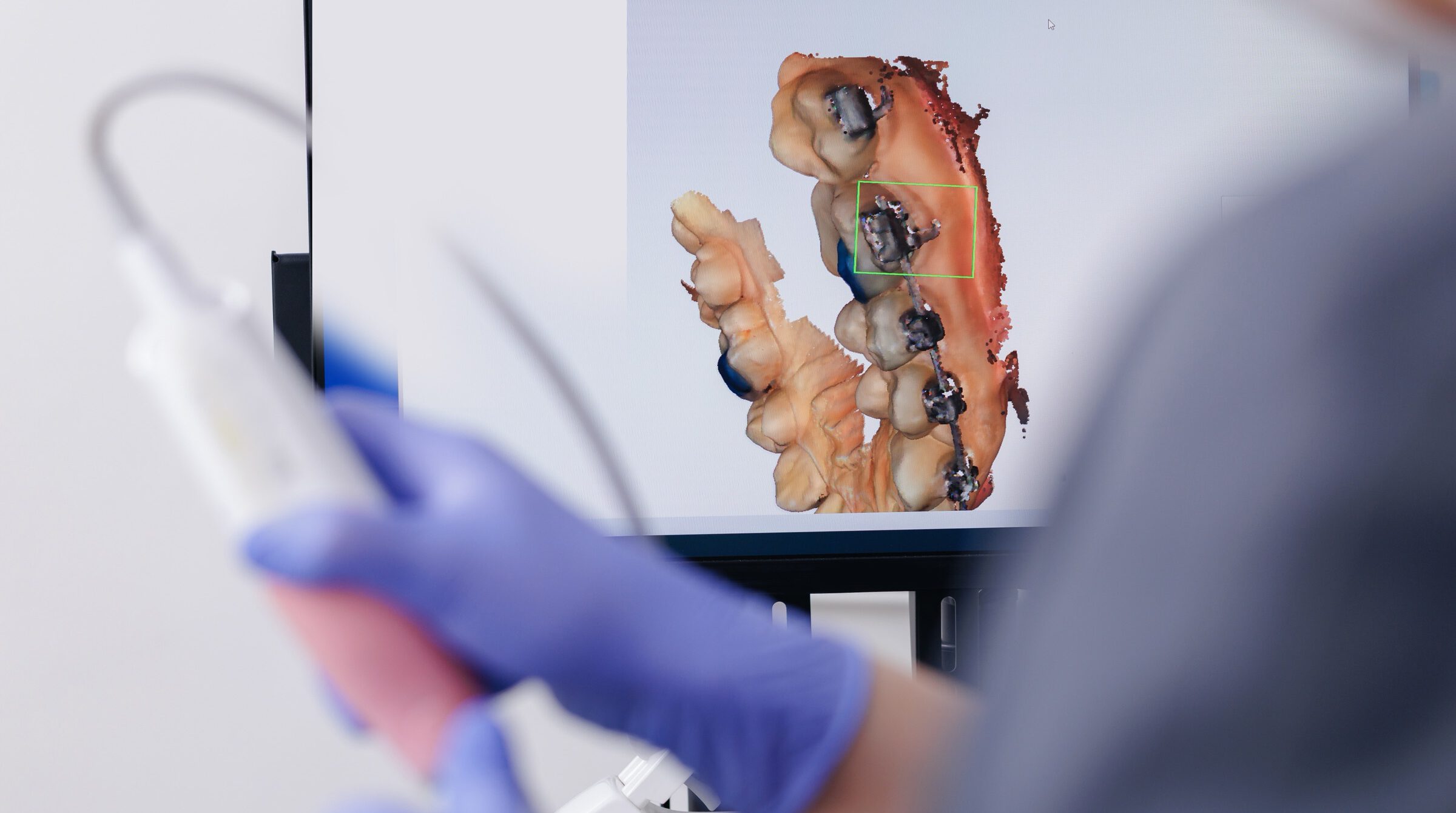 A 3D digital scan of teeth displayed on a monitor, with the scanner held in the foreground