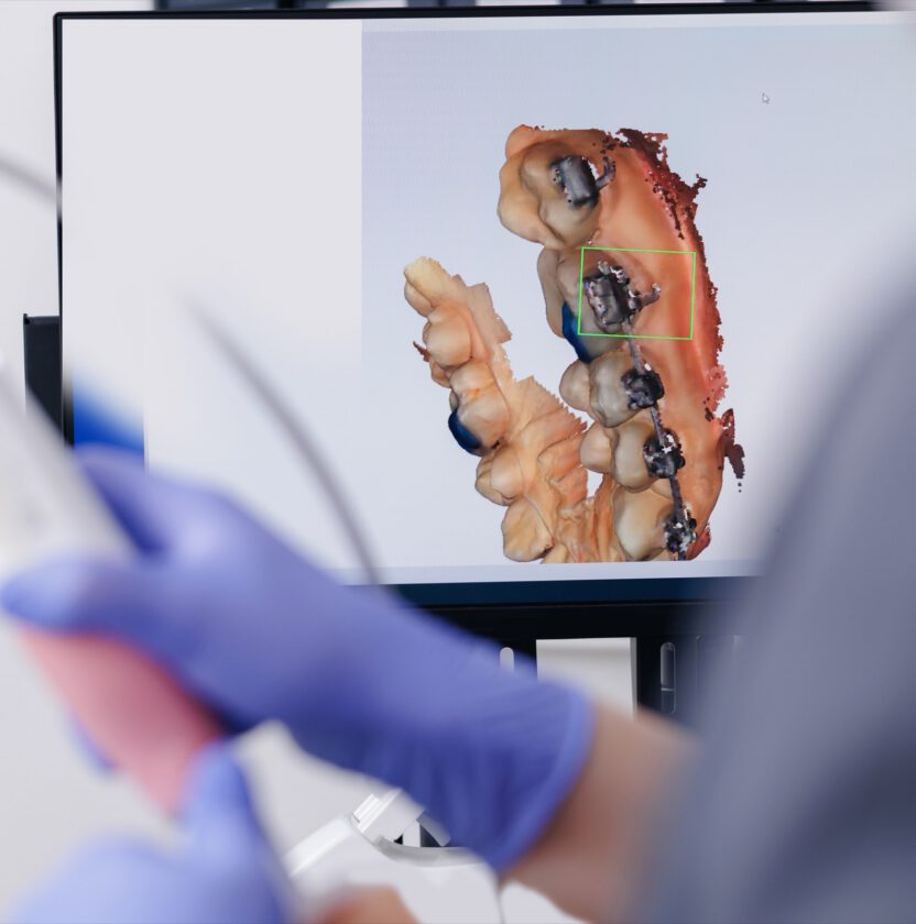 A 3D digital scan of teeth displayed on a monitor, with the scanner held in the foreground